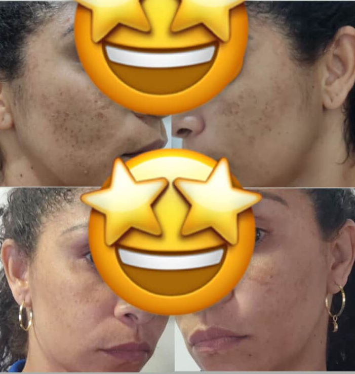 melasma